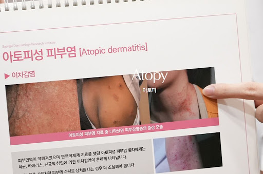 생기한의원이 설명하는 아토피 연고 임의 중단 시 주의 사항